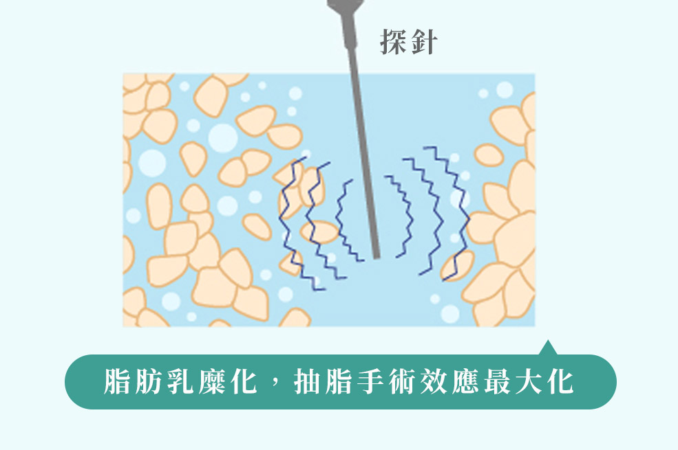 音浪抽脂_乳糜化氣泡效應