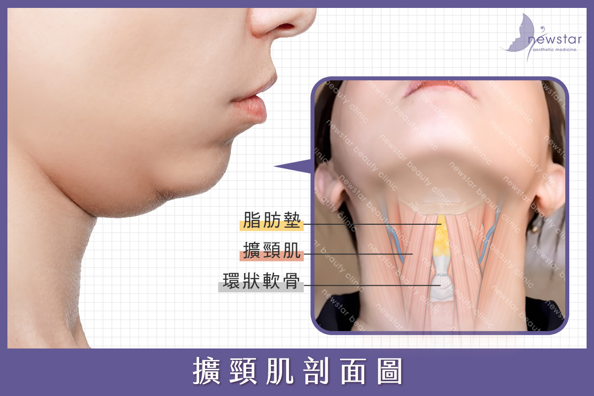 雙下巴擴頸肌剖面圖解