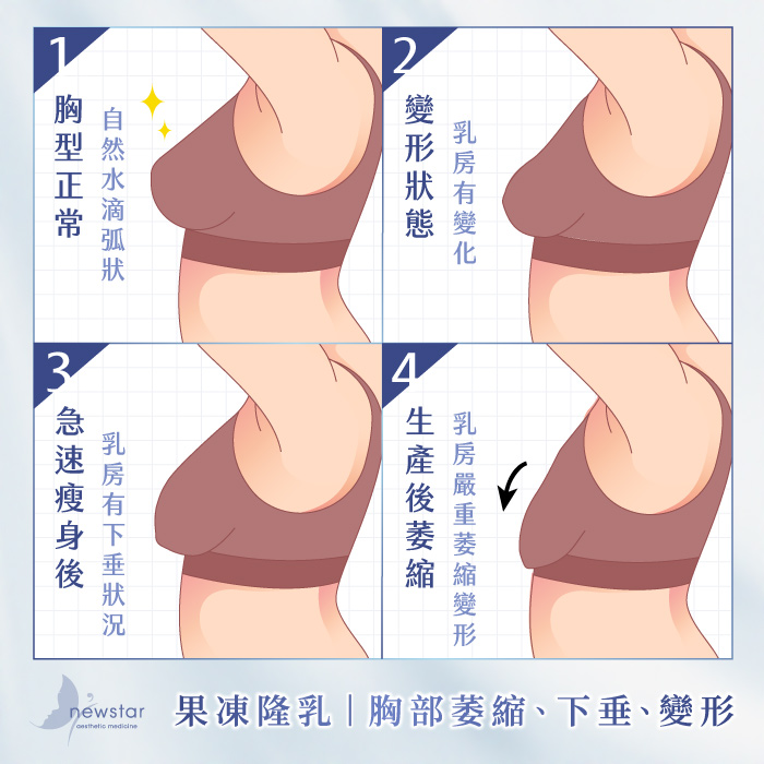 腹部拉皮手術｜果凍隆乳