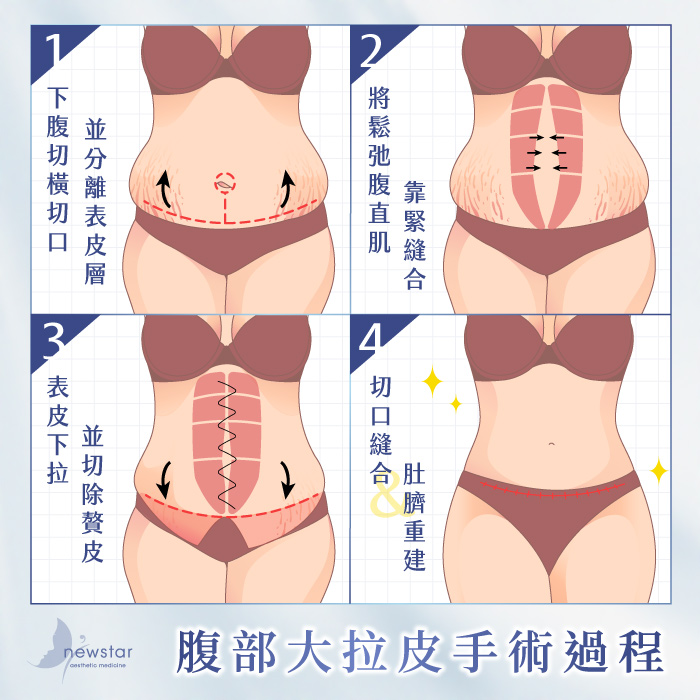 腹部拉皮手術｜腹部大拉皮_手術過程