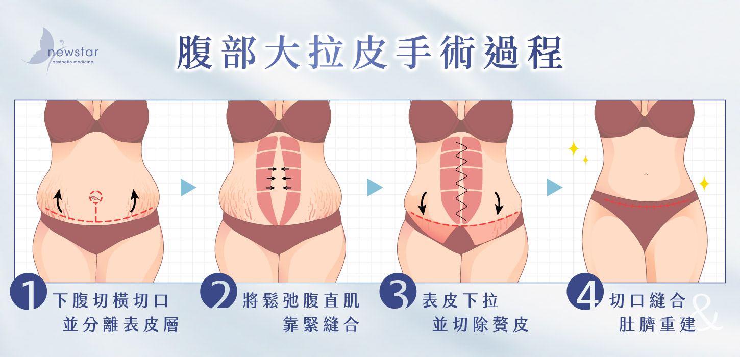 腹部拉皮手術｜腹部大拉皮_手術過程