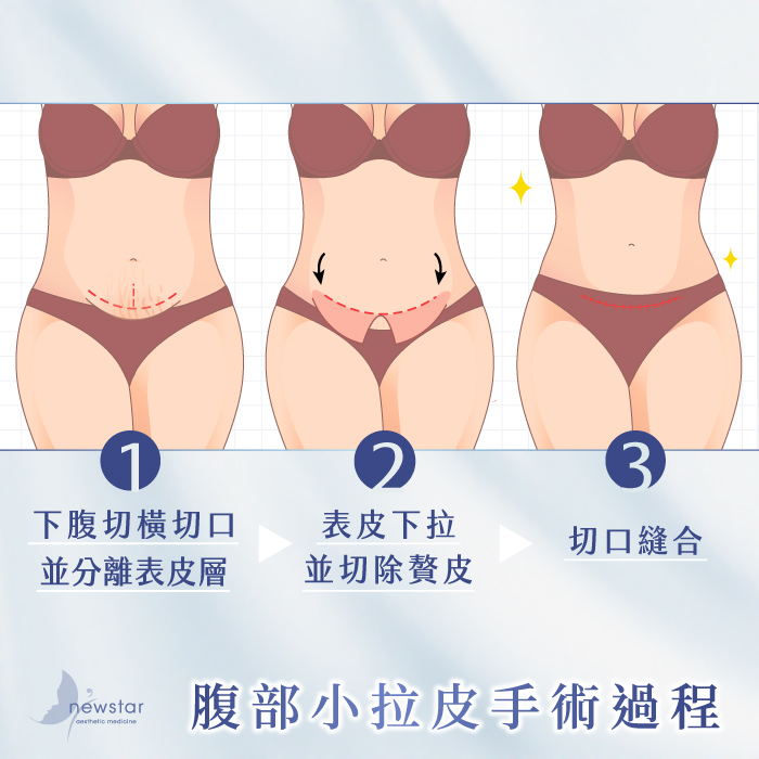 腹部拉皮手術｜腹部小拉皮_手術過程