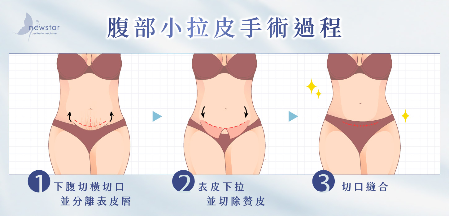 腹部拉皮手術｜腹部小拉皮_手術過程