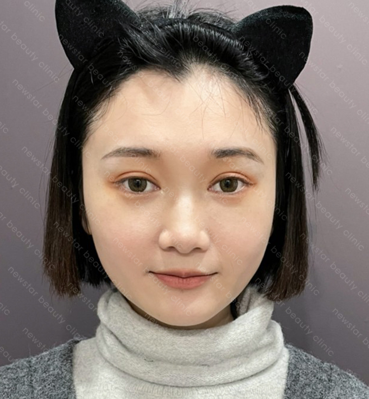 自體脂肪豐臉_案例_術後(正面)