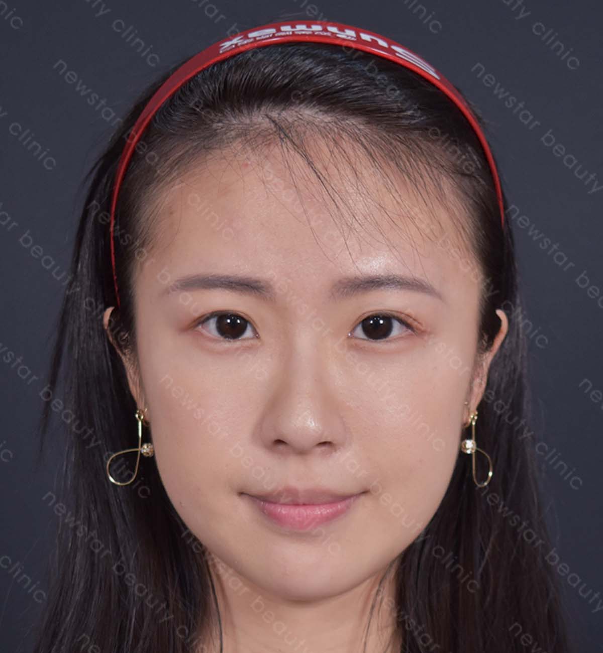 眼袋手術_術後案例