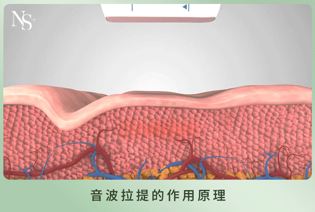 音波拉提_原理