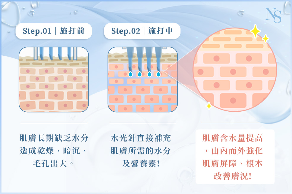 水光針原理介紹