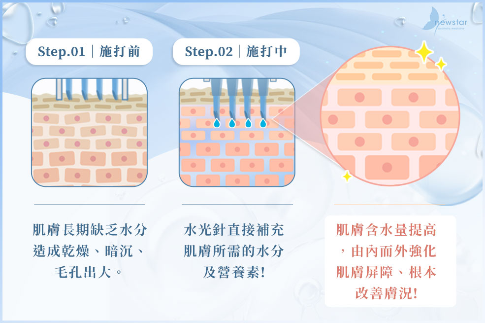 水光針原理介紹