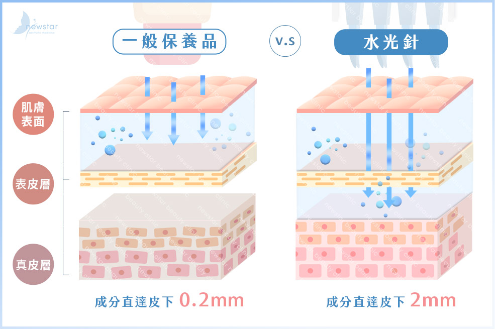 水光針功效_一般保養品VS水光槍