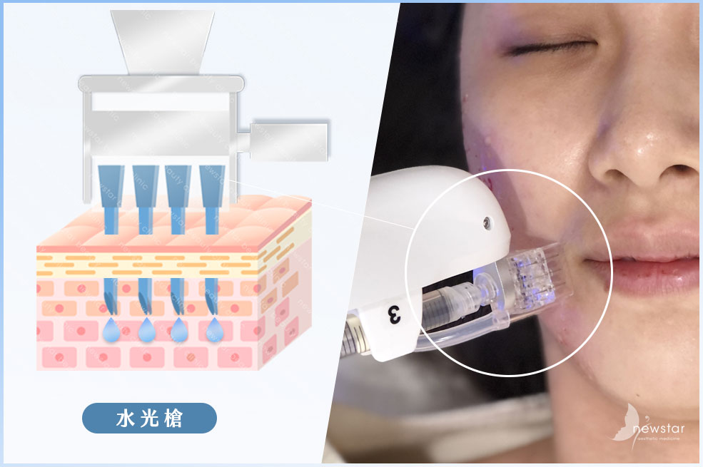 水光槍施打效果差異