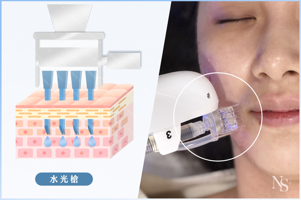 水光槍施打效果差異