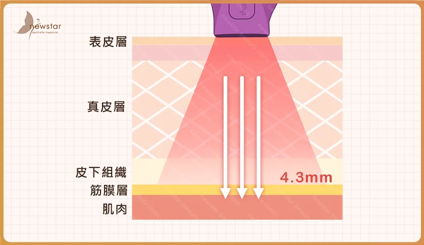 臉部拉提_電波拉皮原理