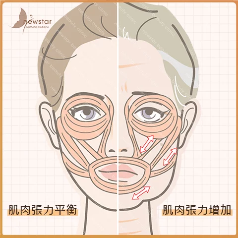 臉部拉提_臉部老化_筋