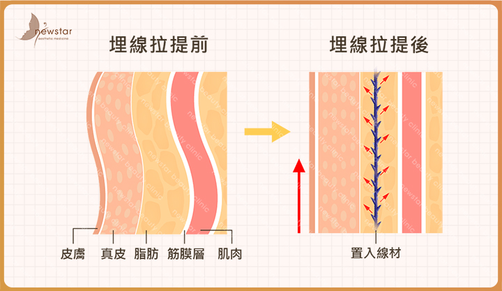 臉部拉提_埋線拉提原理