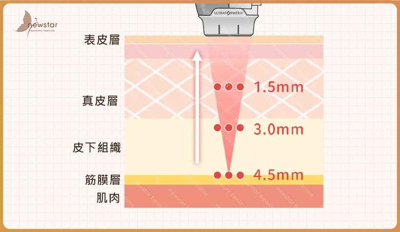 臉部拉提_音波拉提原理