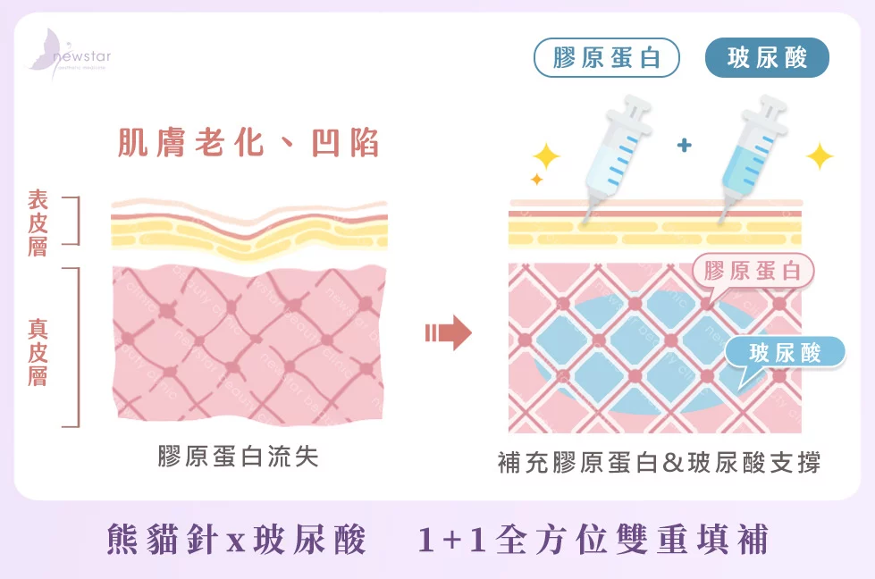 膠原蛋白熊貓針_玻尿酸搭配