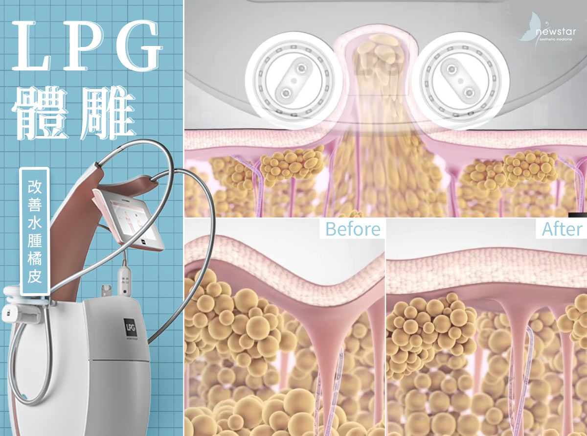 瘦小腿療程_LPG體雕