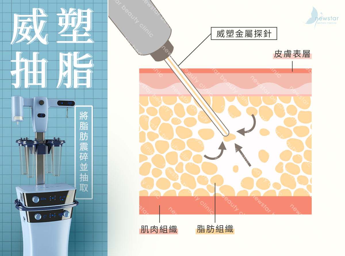 瘦小腿療程_威塑抽脂