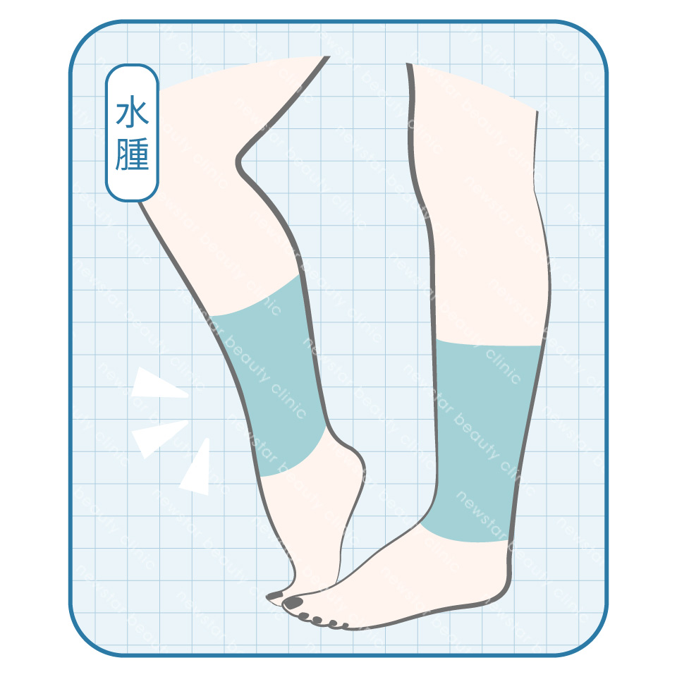瘦小腿療程_水腫型蘿蔔腿