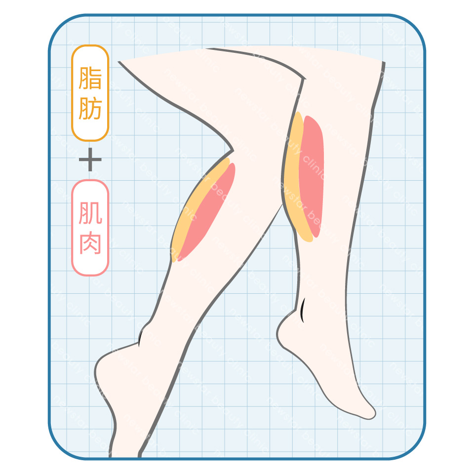 瘦小腿療程_混和型蘿蔔腿
