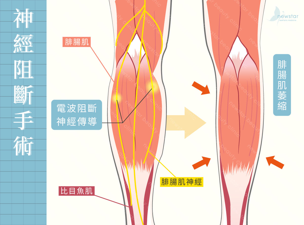 瘦小腿療程_神經阻斷手術
