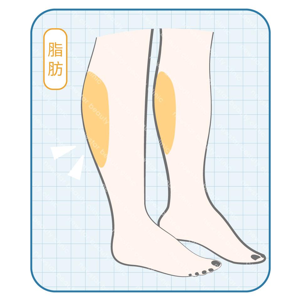 瘦小腿療程_脂肪型蘿蔔腿