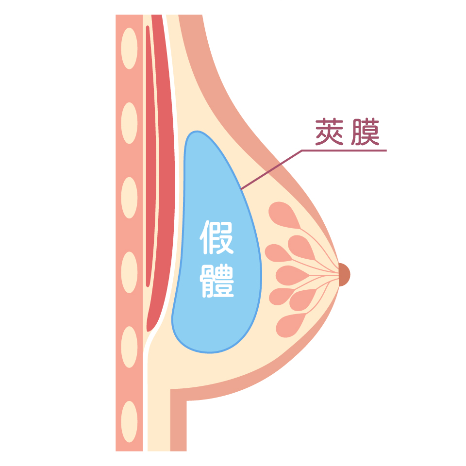 隆乳按摩_莢膜攣縮分級表_第一級