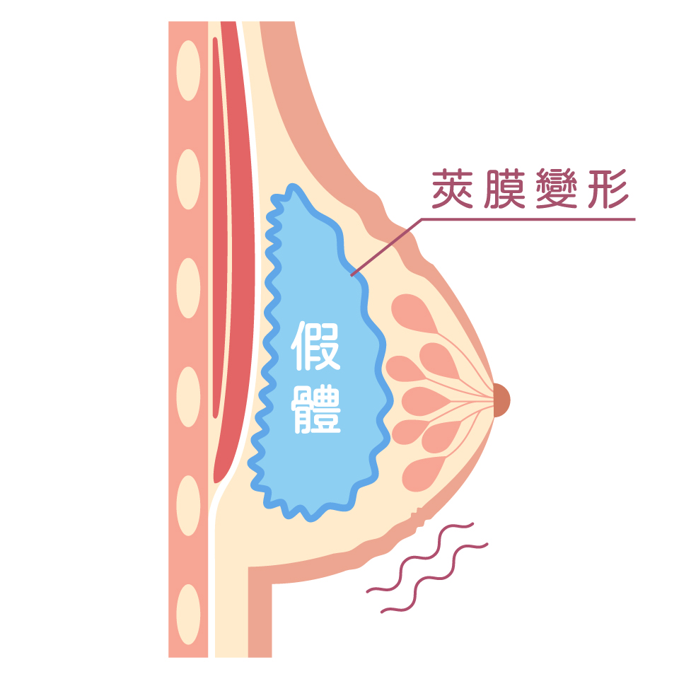 隆乳按摩_莢膜攣縮分級表_第三級