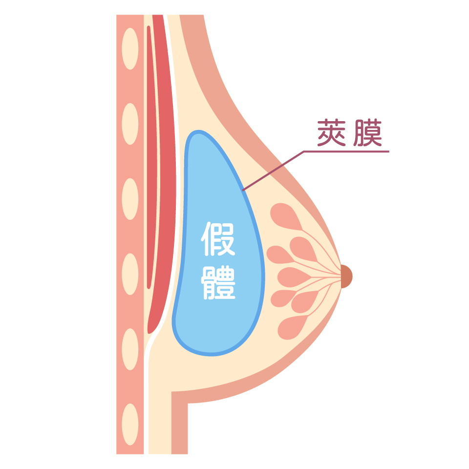 隆乳按摩_莢膜攣縮分級表_第二級