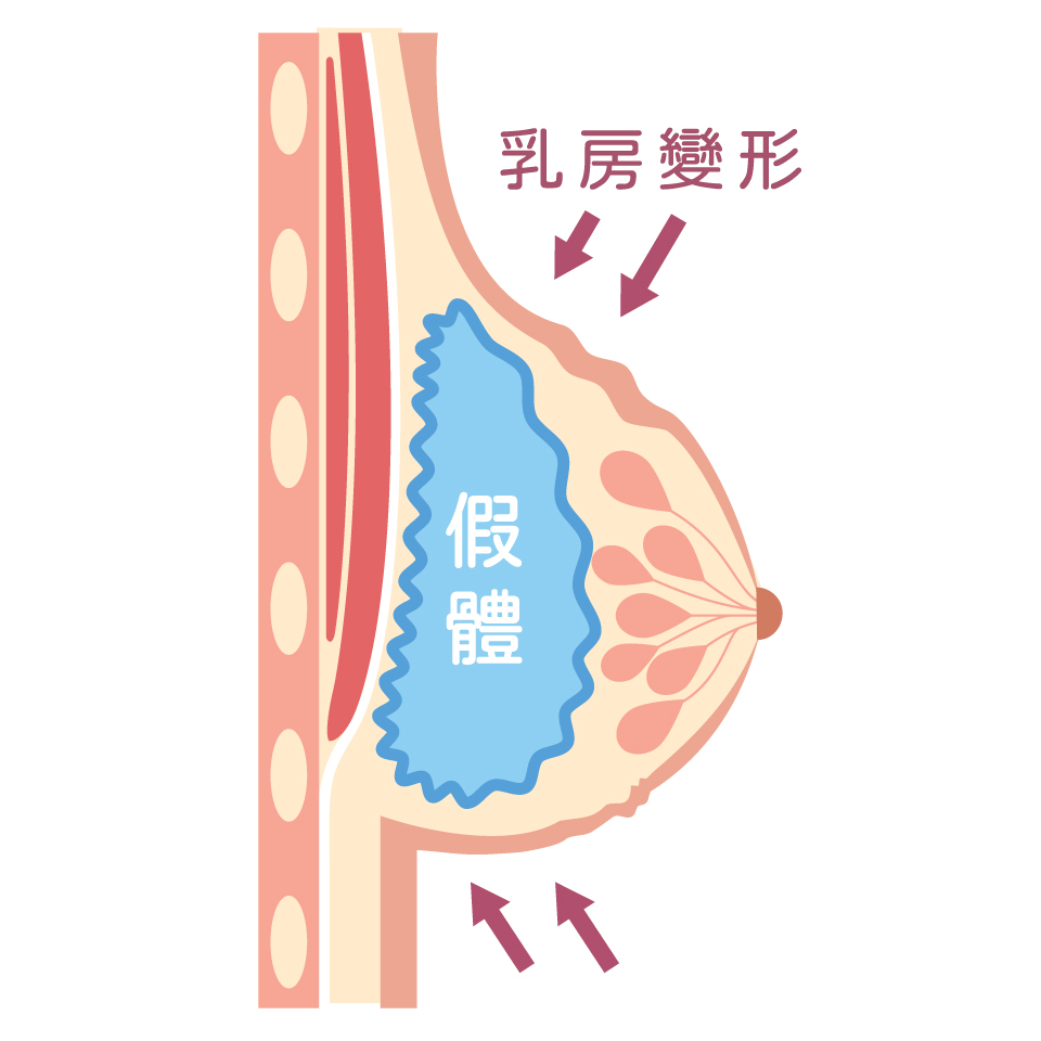 隆乳按摩_莢膜攣縮分級表_第四級