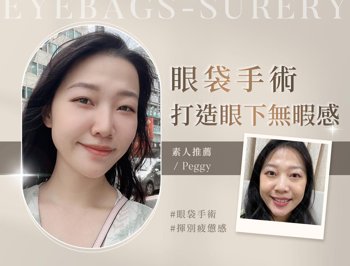 手術官網案例_外bn_peggy03