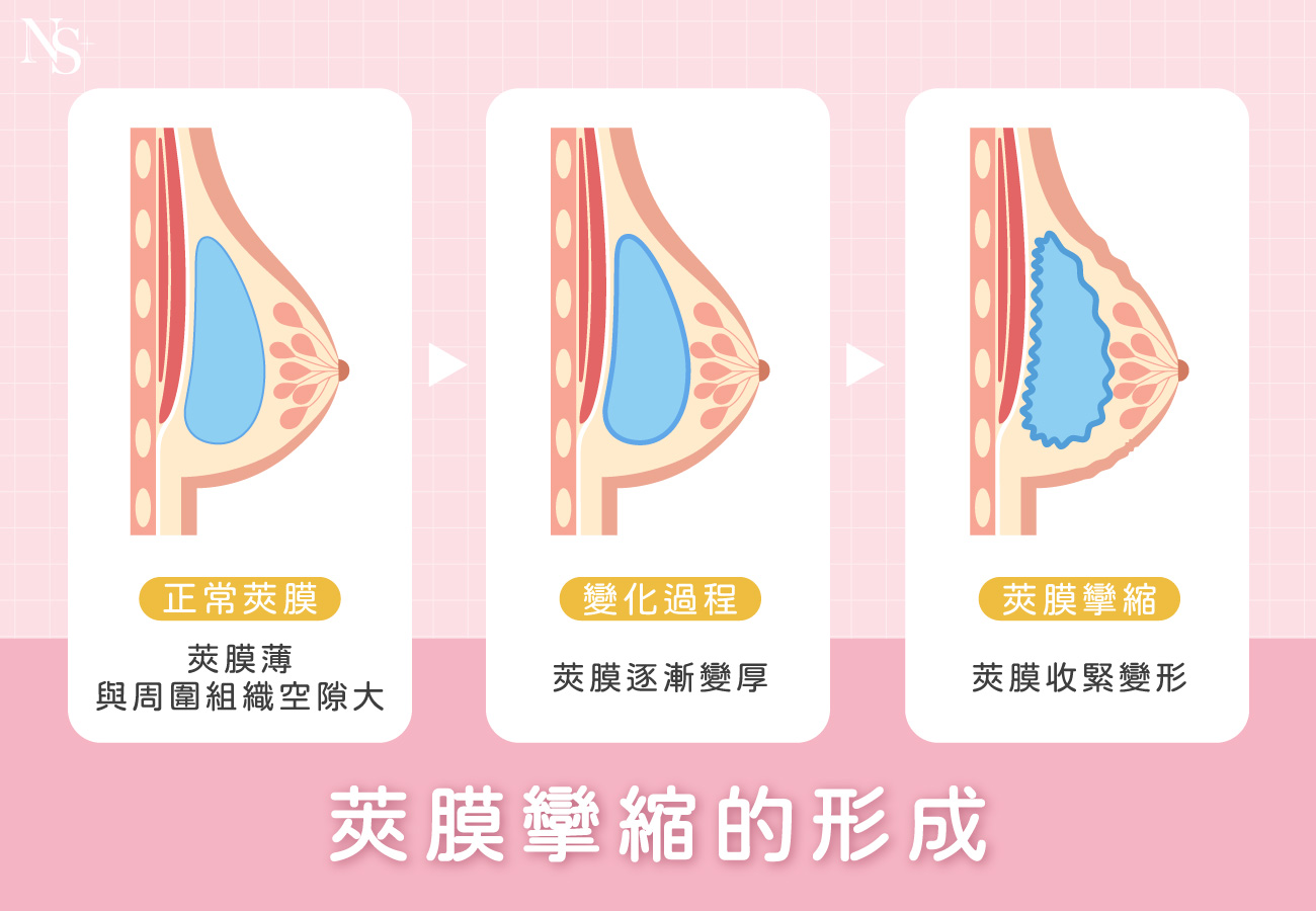 隆乳按摩_莢膜攣縮形成